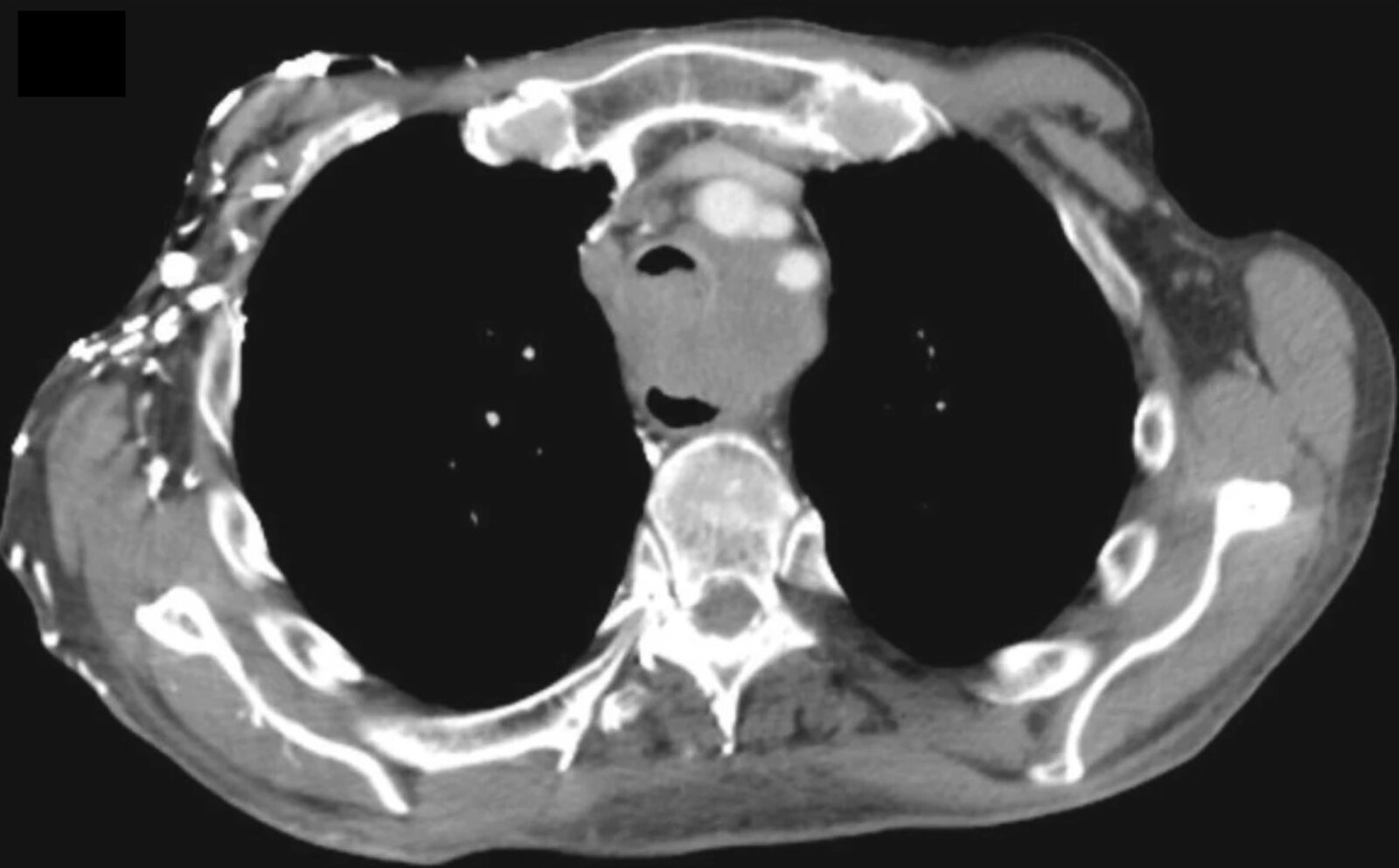Mediastinal mass with narrowed tracheal lumen