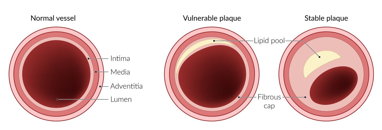 Types of plaques in coronary artery disease