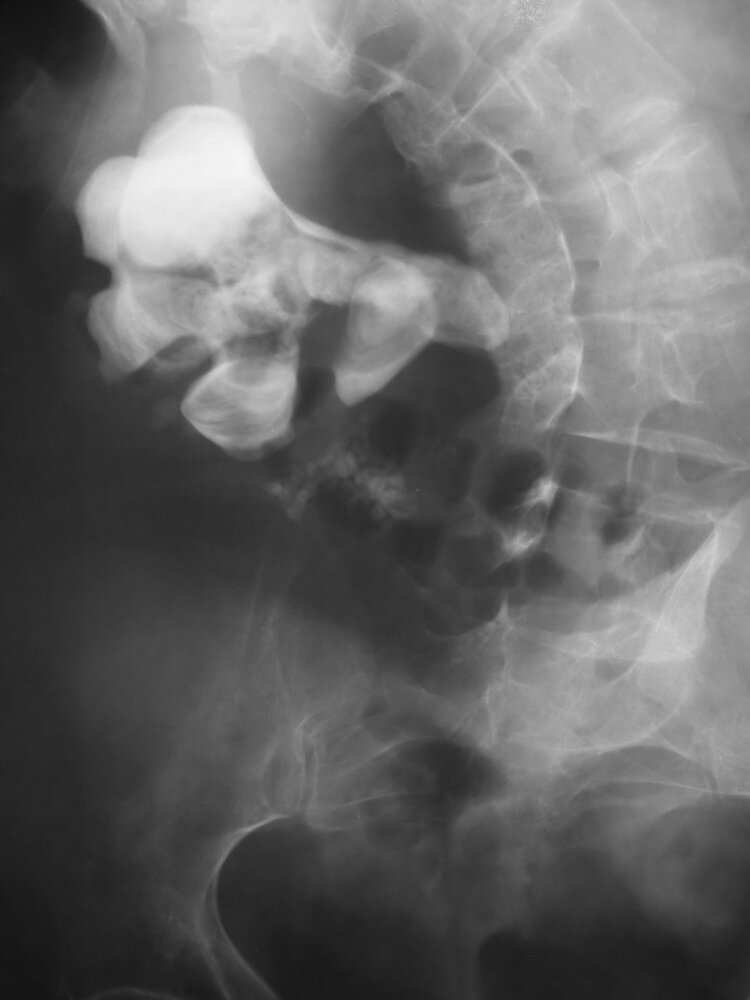 Staghorn calculus