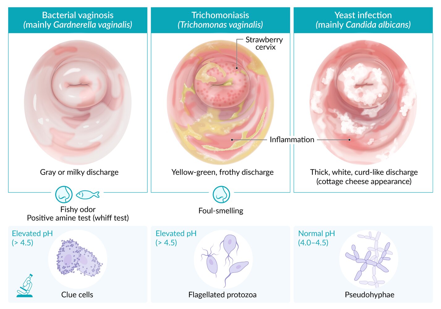 Differential diagnosis of infectious vulvovaginitis