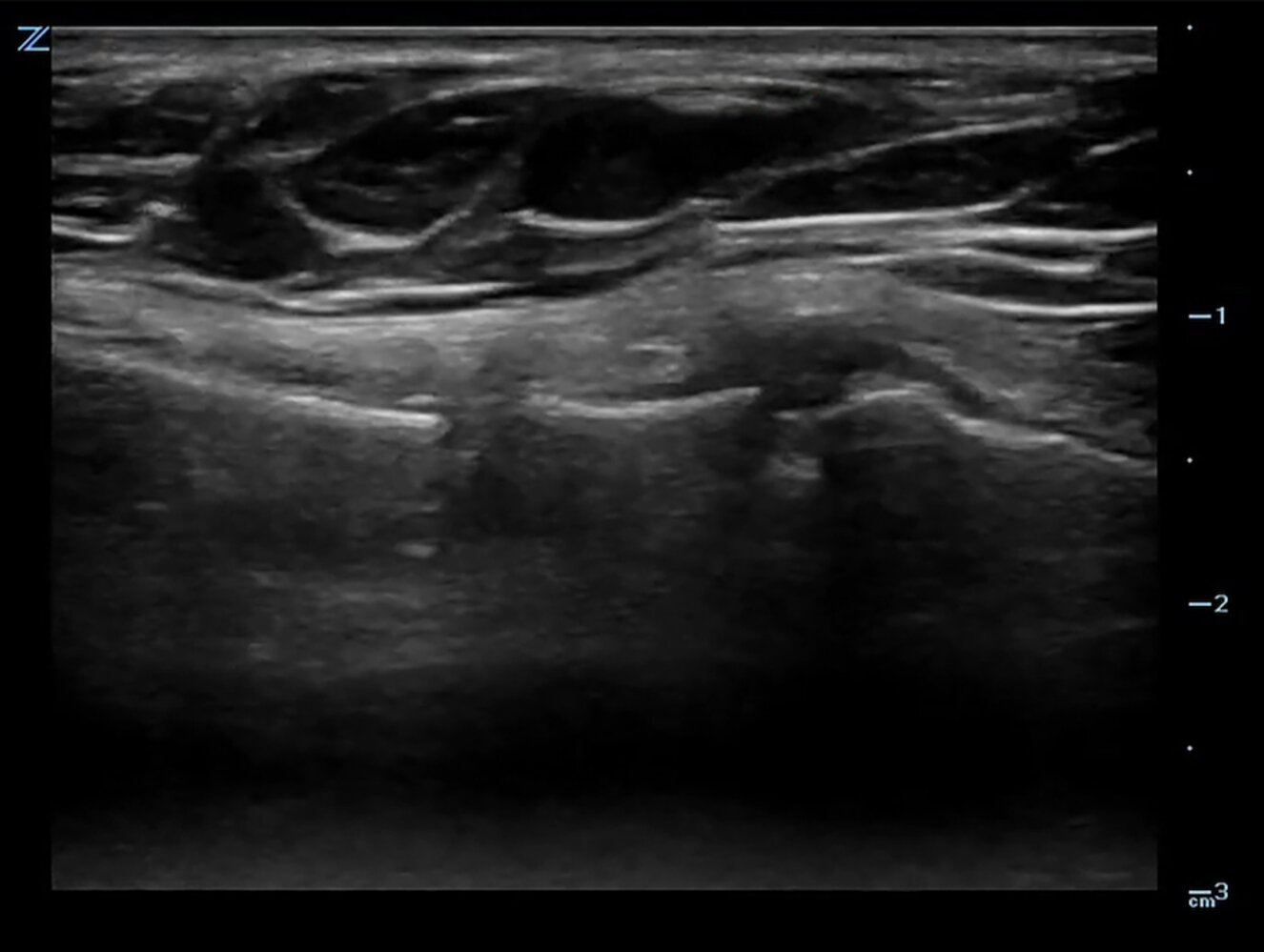 Sternal fracture