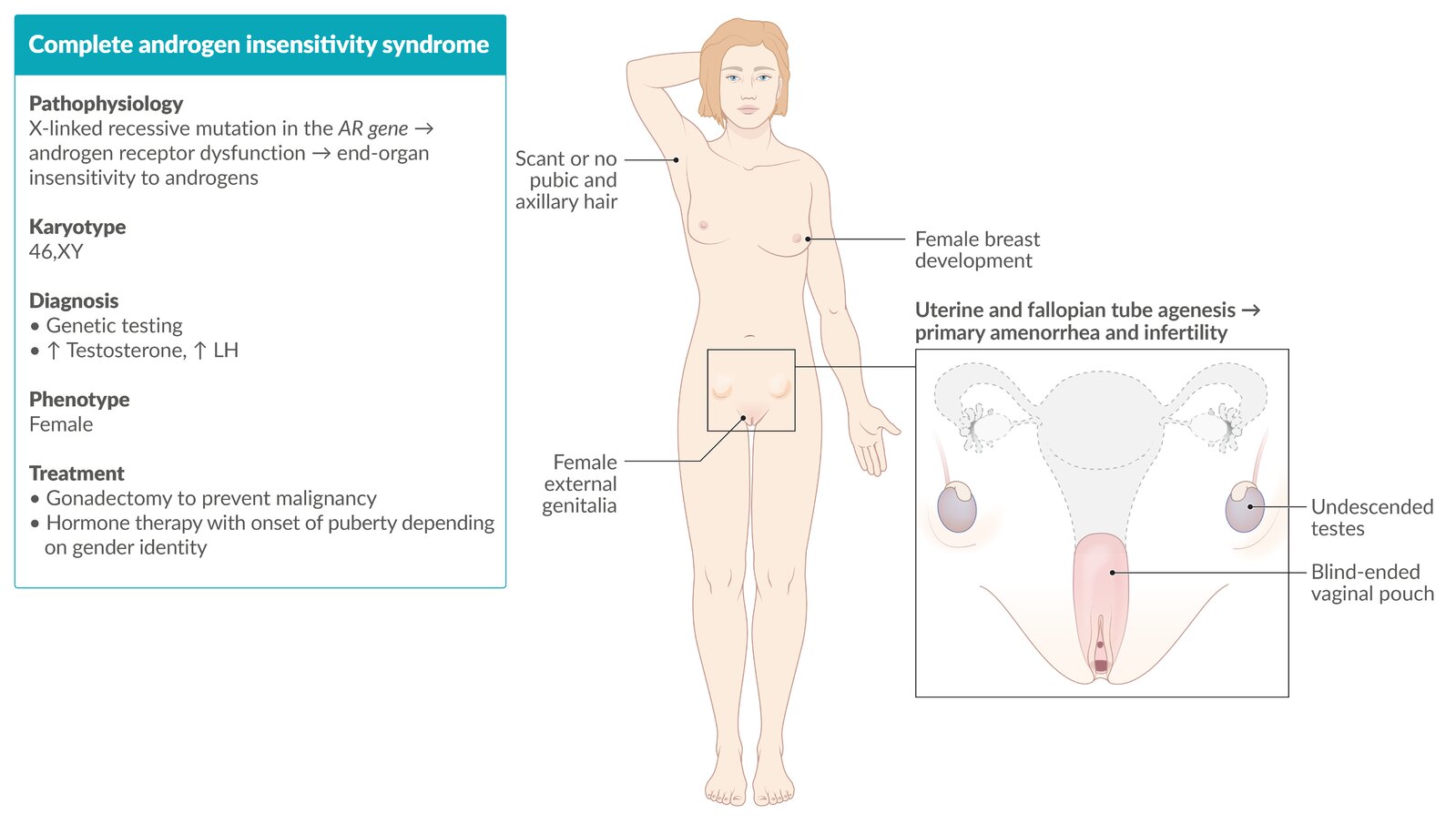 Complete androgen insensitivity syndrome