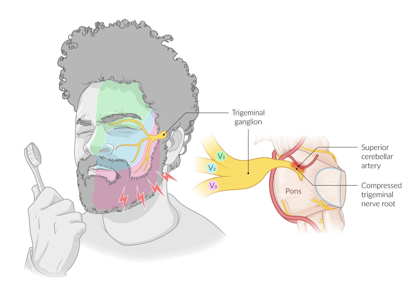 Trigeminal neuralgia