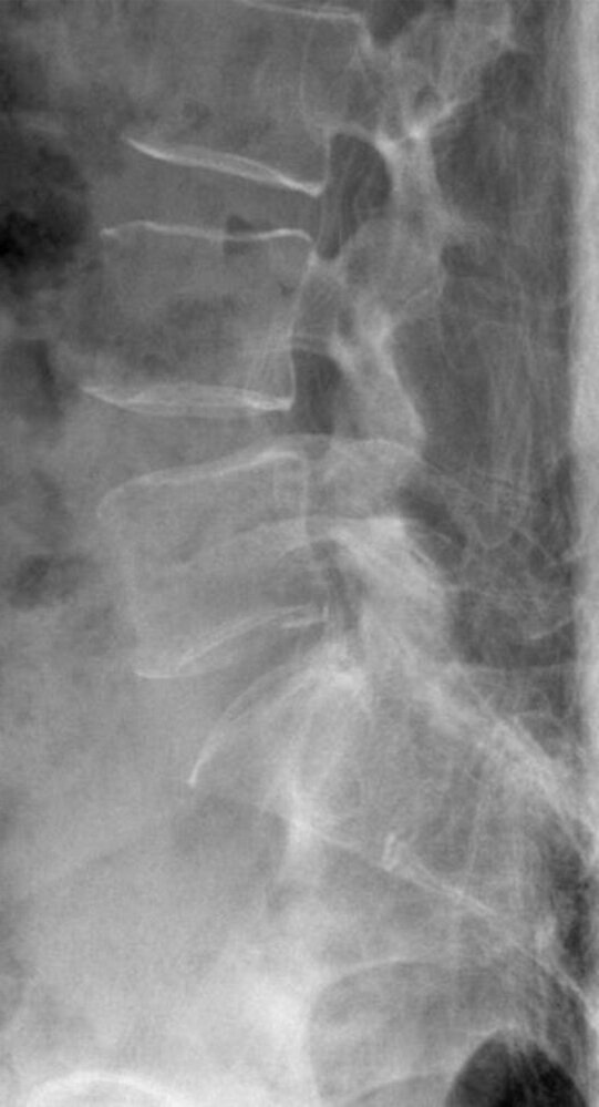 Decreased bone density in osteoporosis