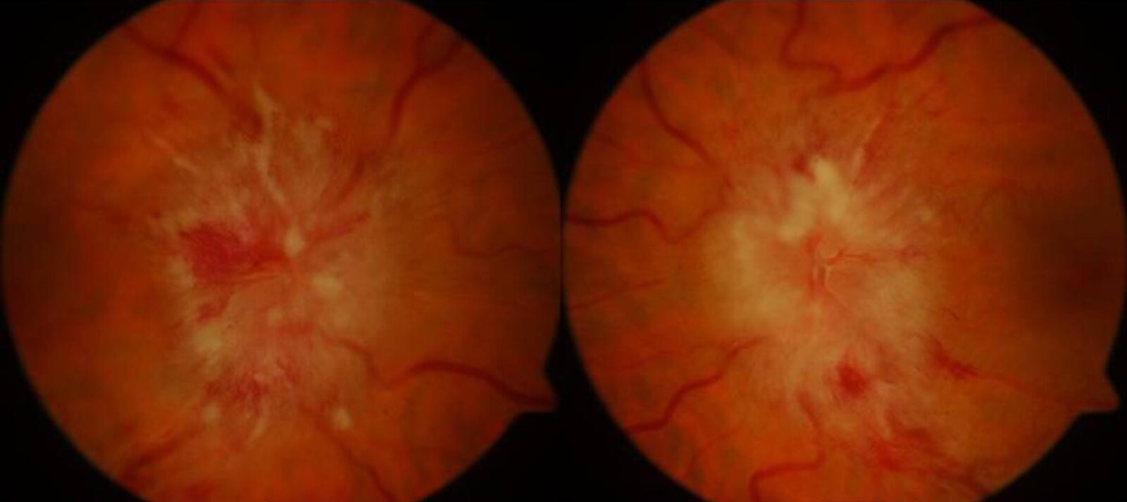 Bilateral papilledema