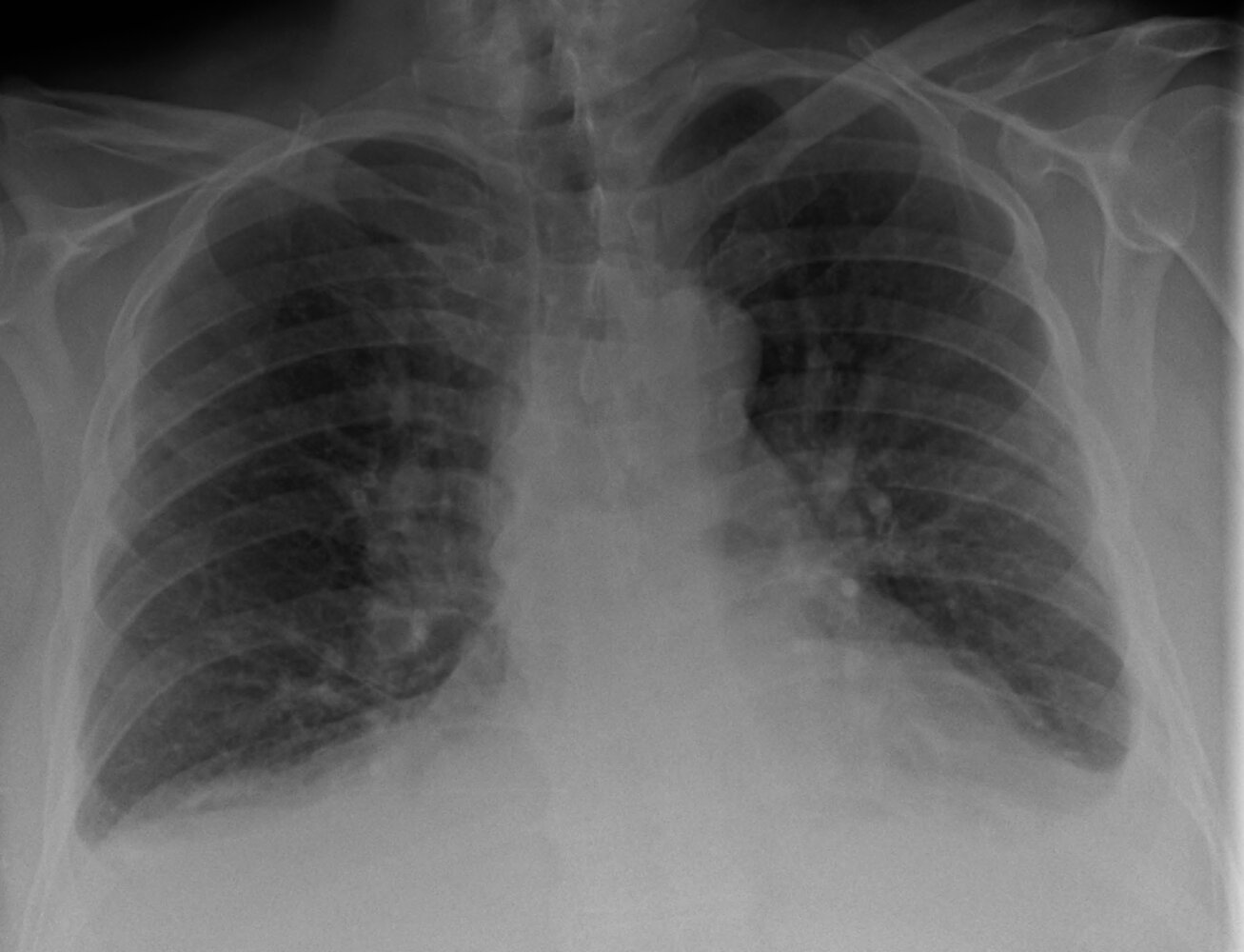 Cardiogenic pulmonary edema