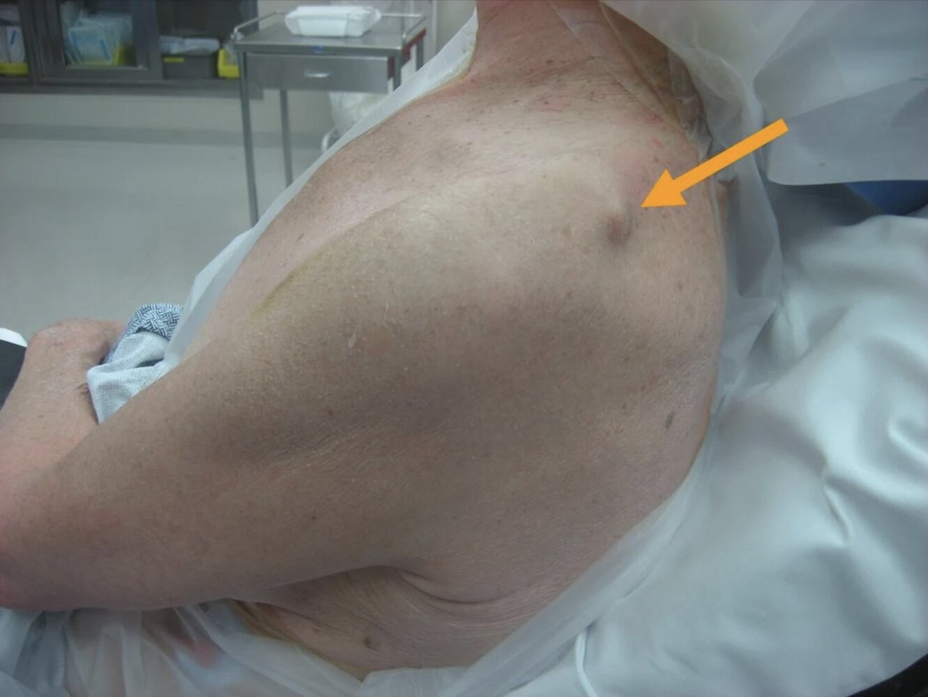 Skin tenting