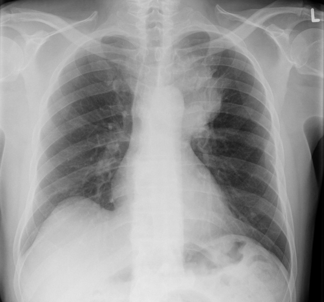 Lung mass