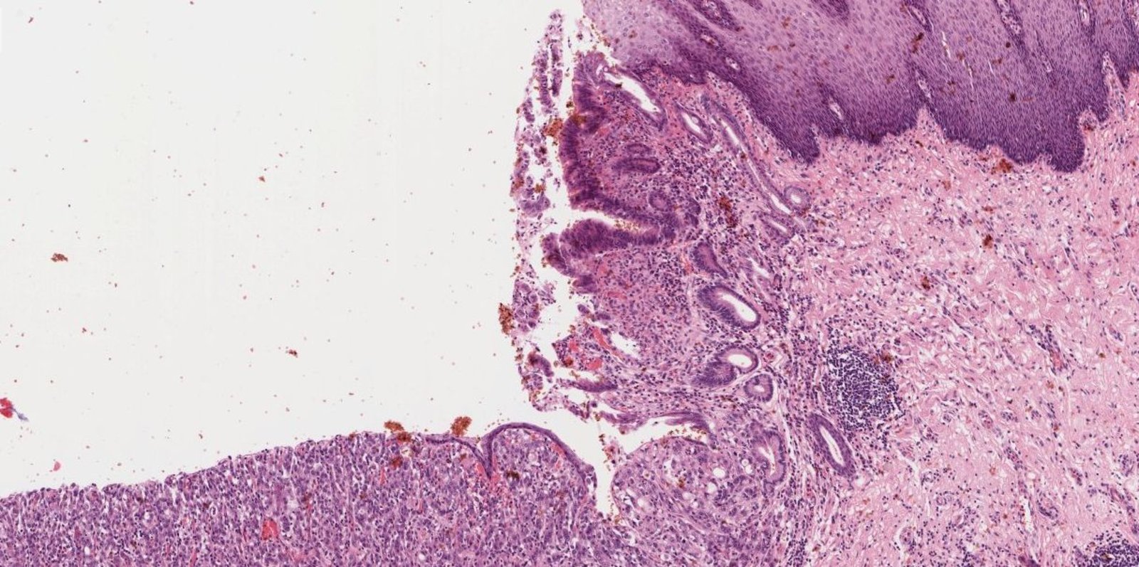 Barrett esophagus with adenocarcinoma