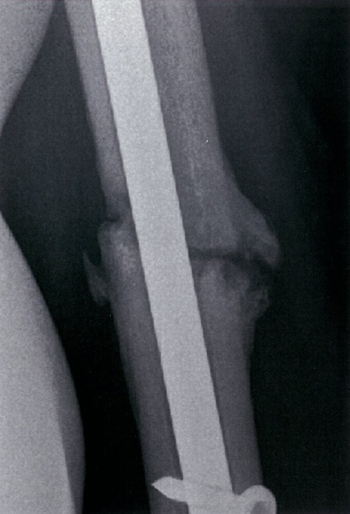 Hypertrophic nonunion of humeral fracture (2/2)