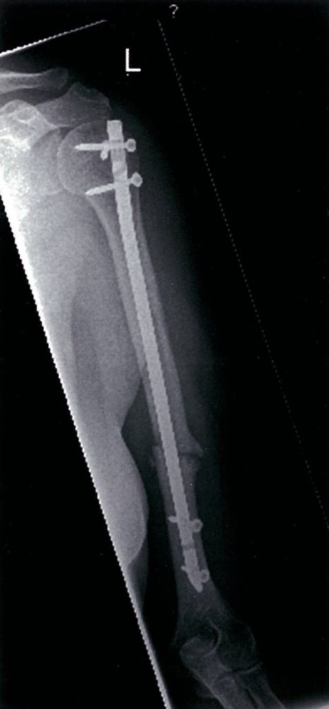 Hypertrophic nonunion of humeral fracture (1/2)