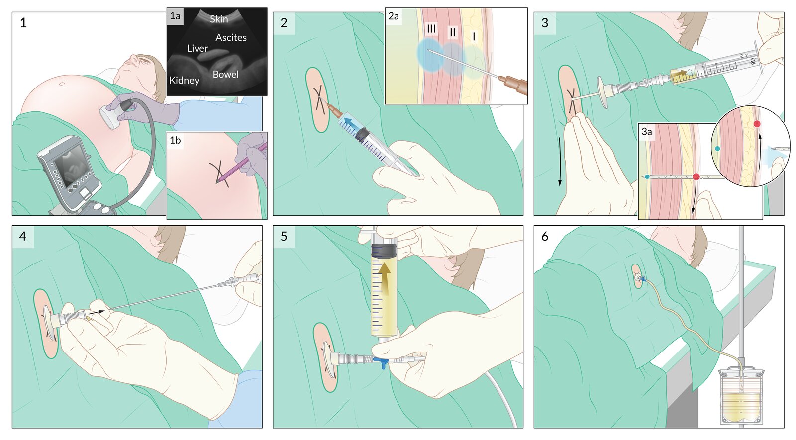 Paracentesis