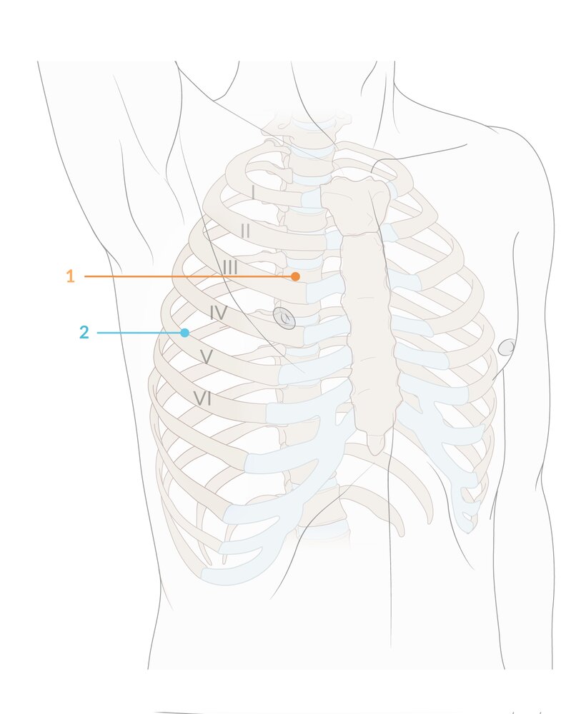 Thoracostomy sites