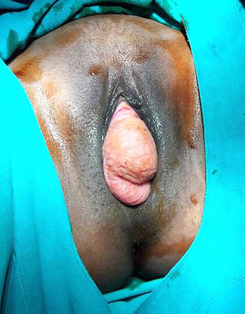 Stage 3 pelvic organ prolapse