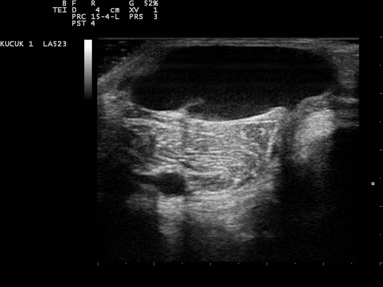 Ultrasound of popliteal (Baker) cyst