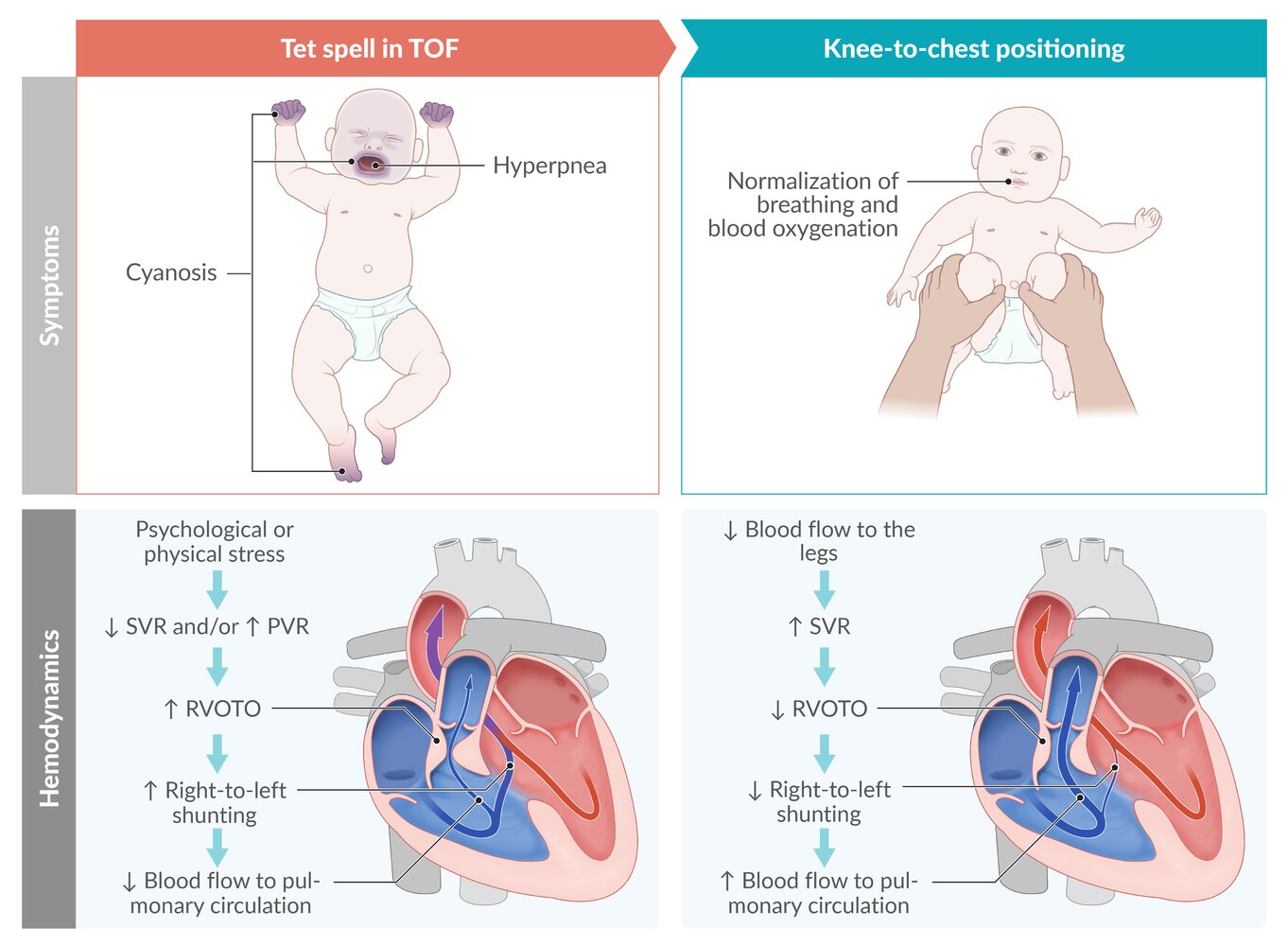 Tet spell in tetralogy of Fallot