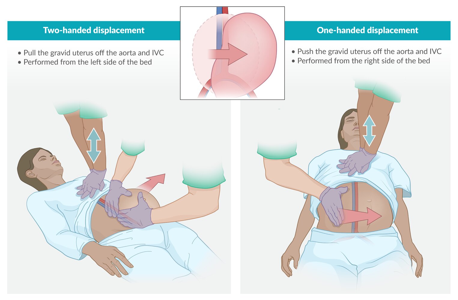 Uterine displacement during cardiopulmonary resuscitation (CPR)