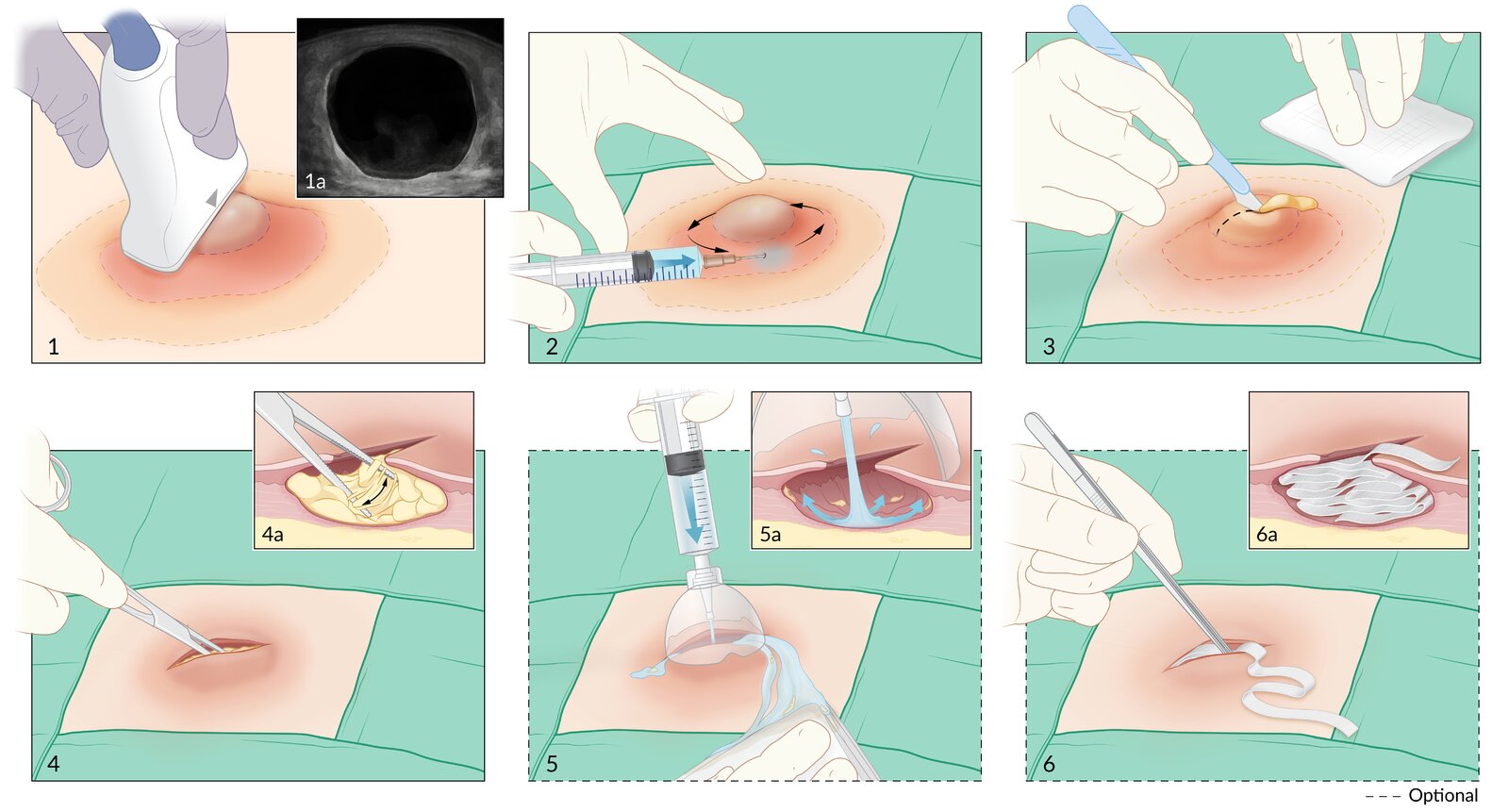 Abscess incision and drainage