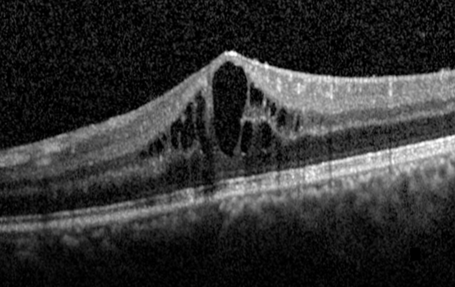 Cystoid macular edema