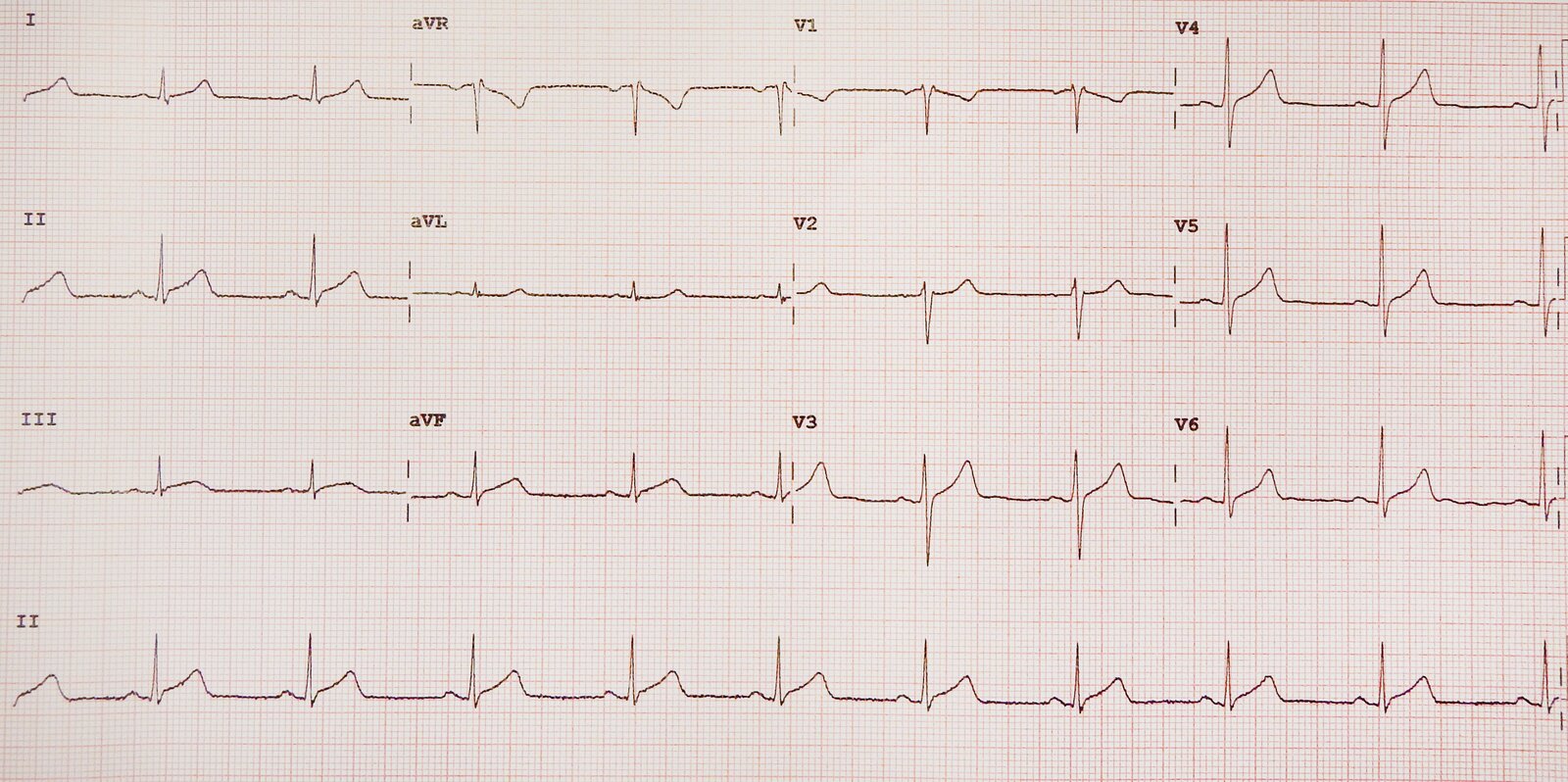Acute pericarditis