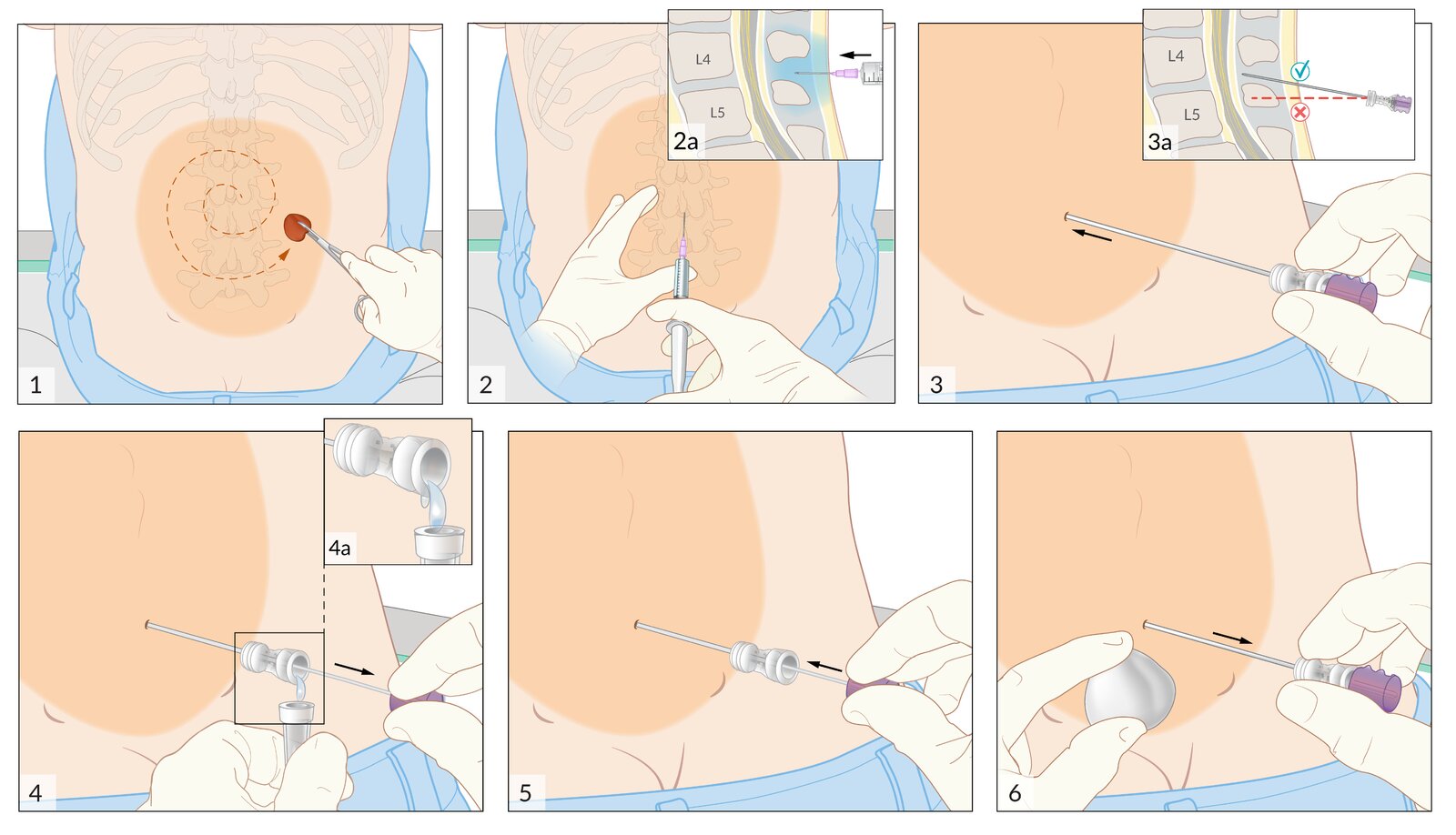 Lumbar puncture (2/2): procedure