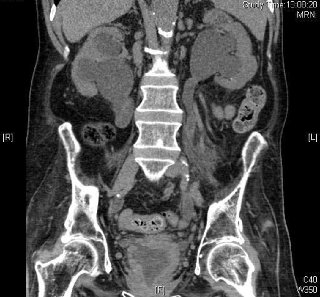 Chronic ureteral obstruction