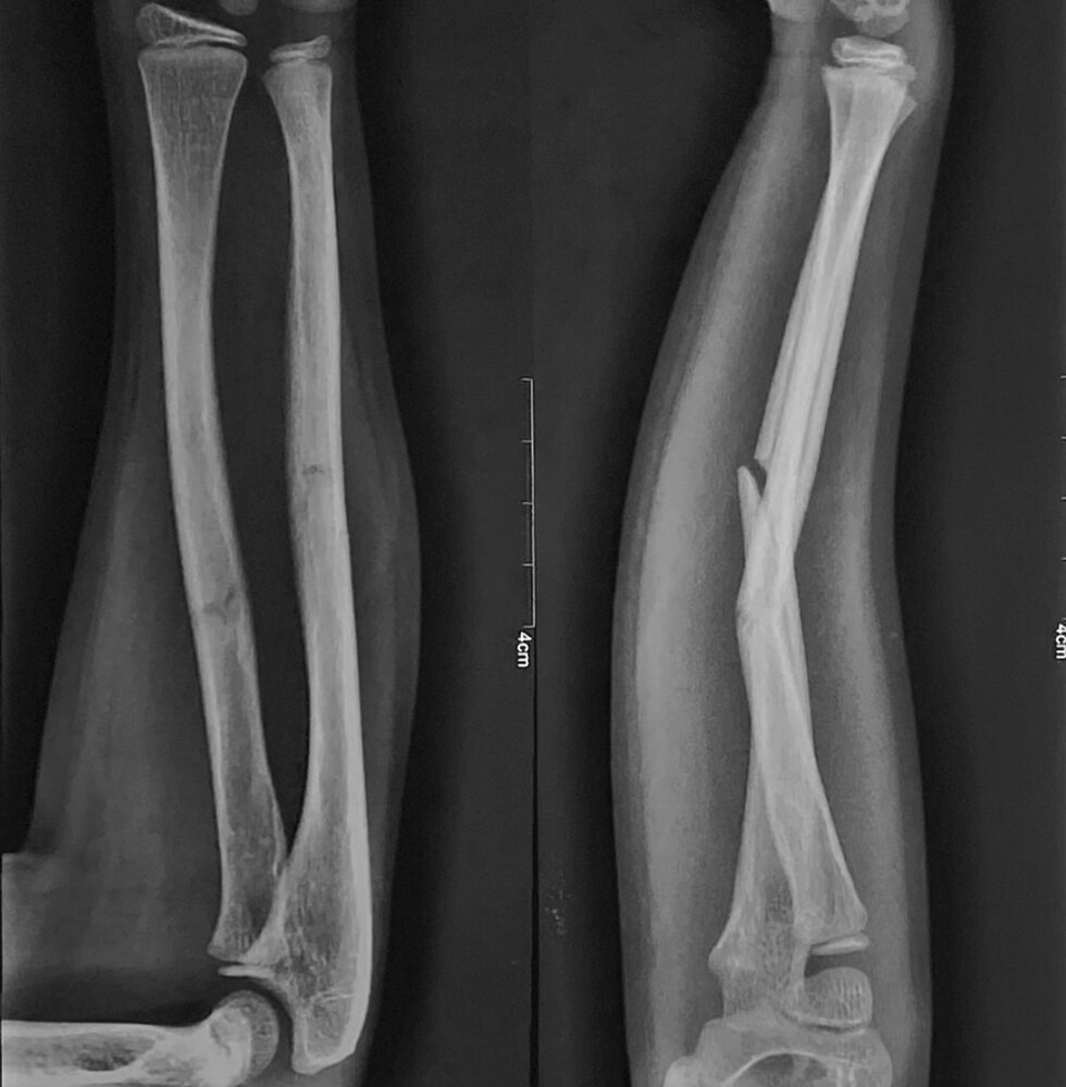 Mid diaphyseal radial and ulnar fractures