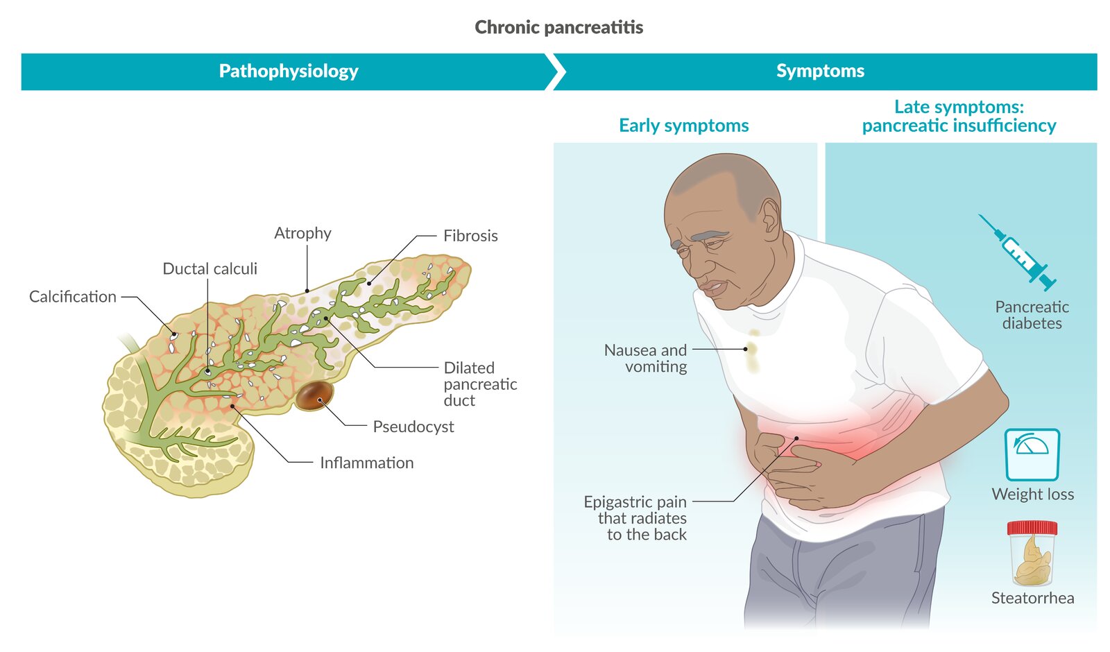 Chronic pancreatitis