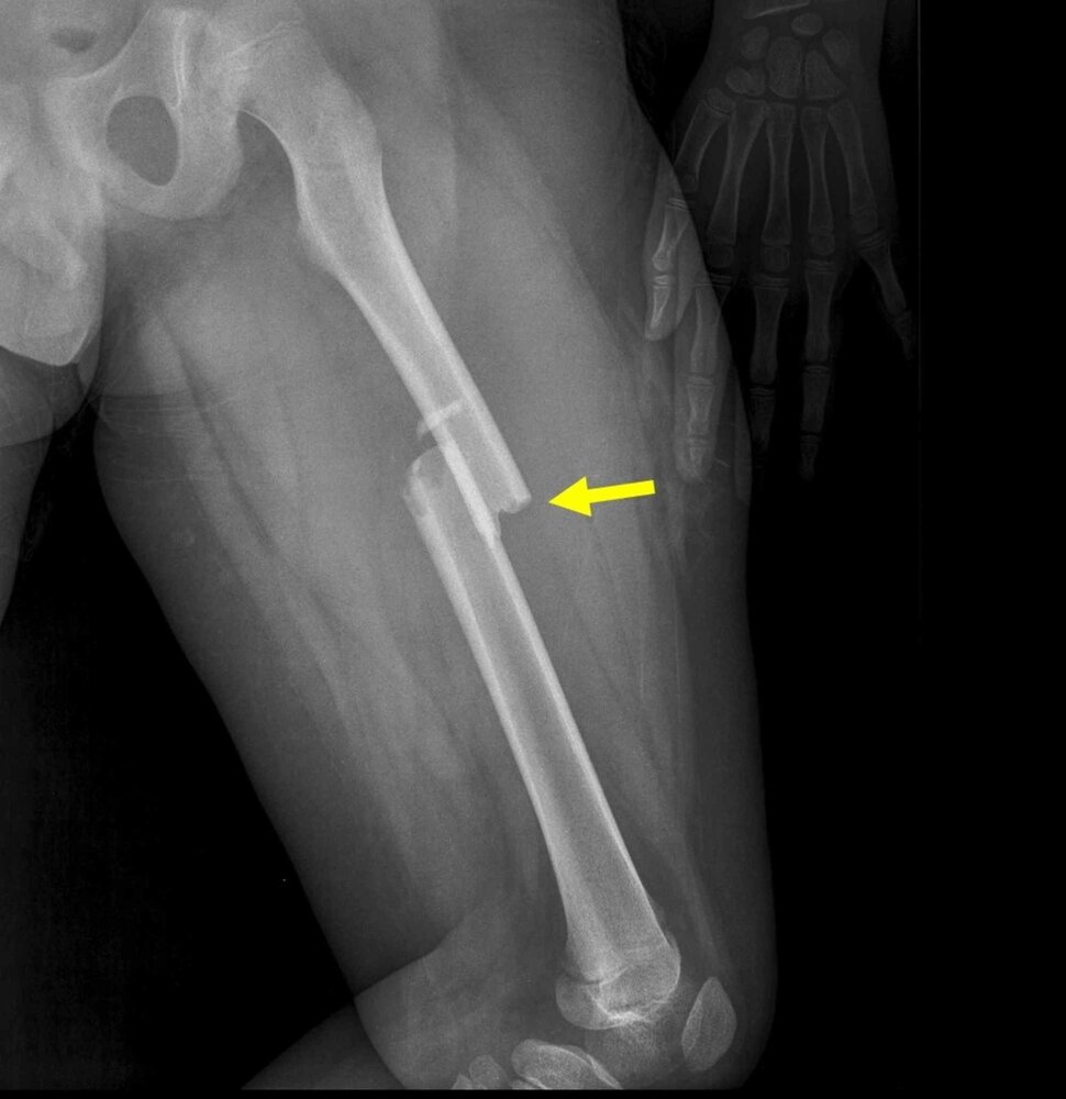 Acute femoral shaft fracture in a child 1/2