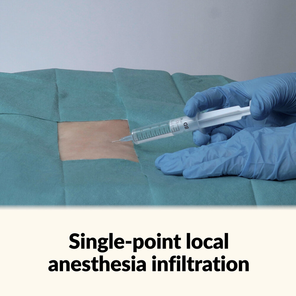 Single-point local anesthesia infiltration | AMBOSS