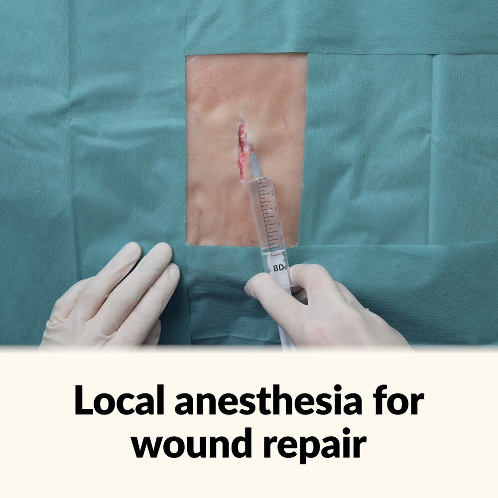 Local anesthesia for wound repair | AMBOSS
