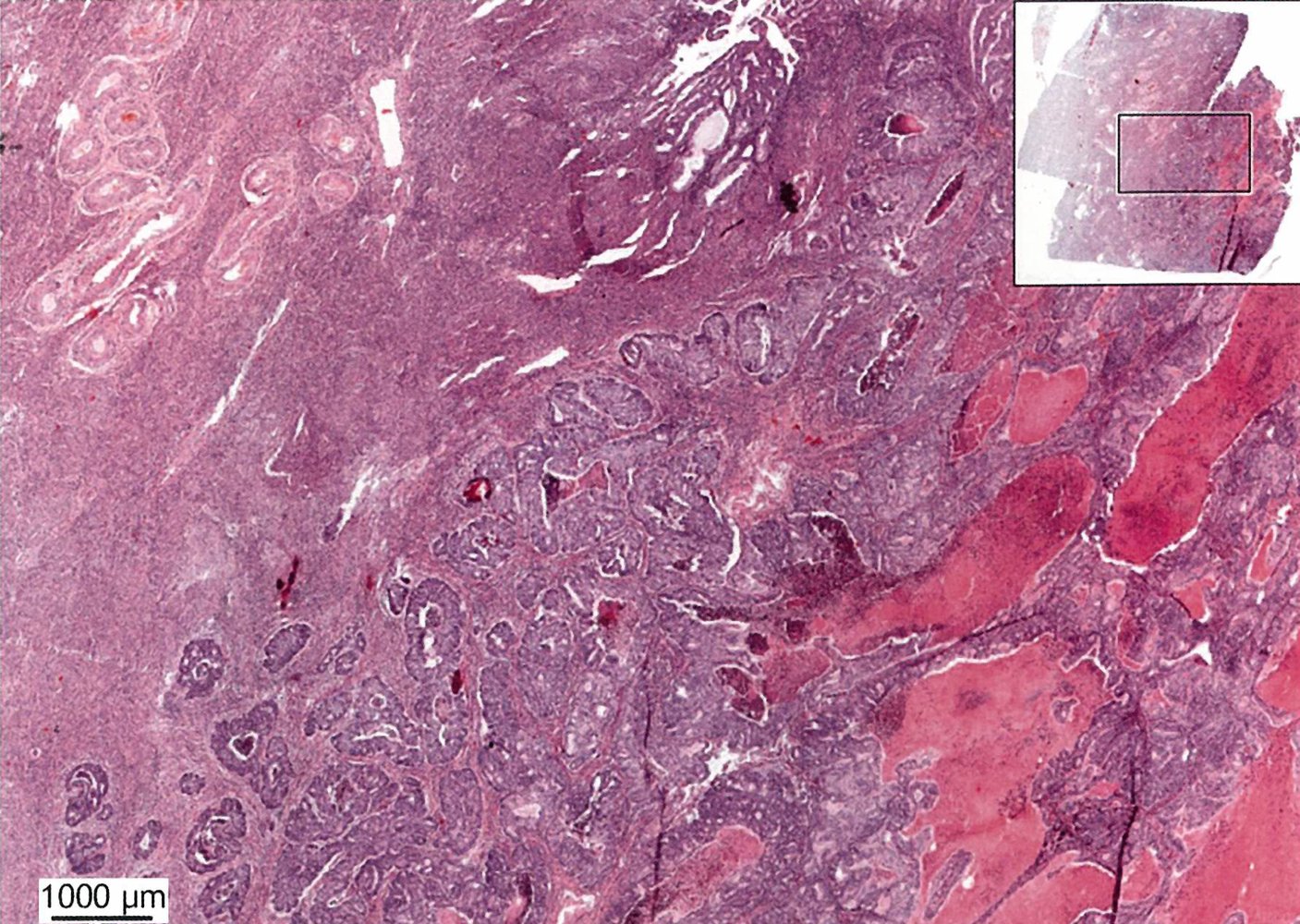Endometrioid adenocarcinoma (1/3)