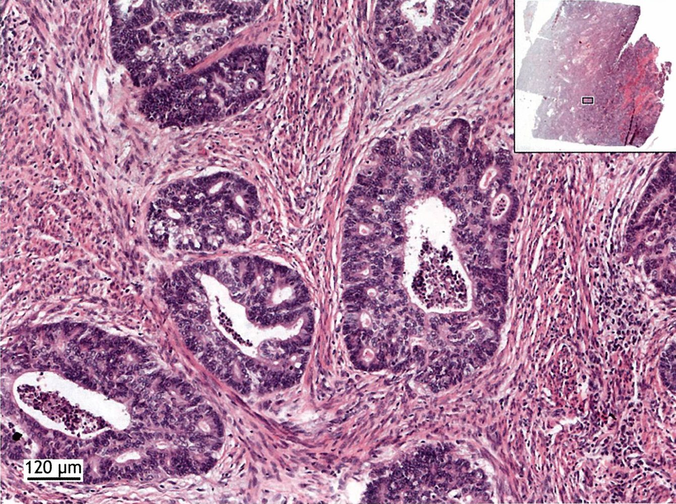 Endometrioid adenocarcinoma (2/3)