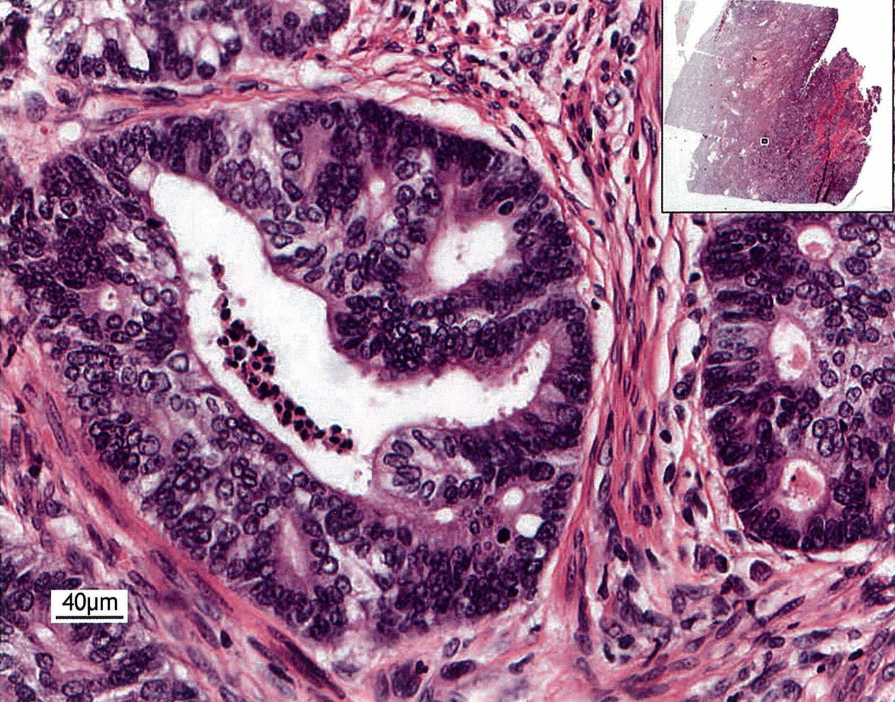 Endometrioid adenocarcinoma (3/3)