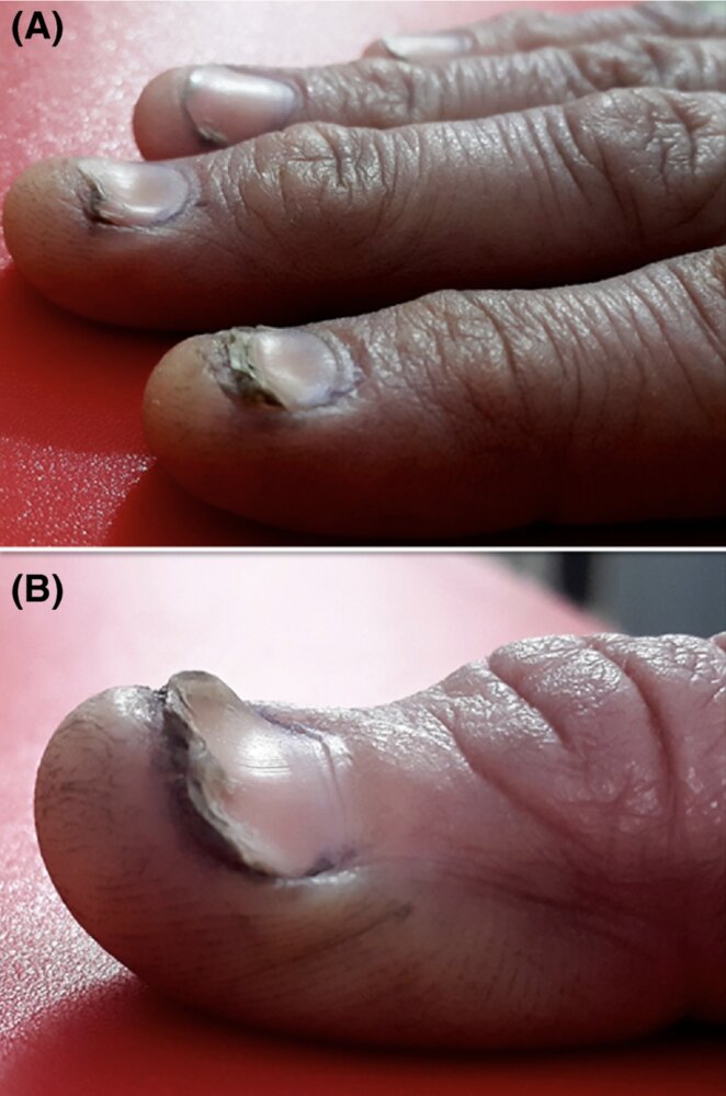 Koilonychia (spoon nails)