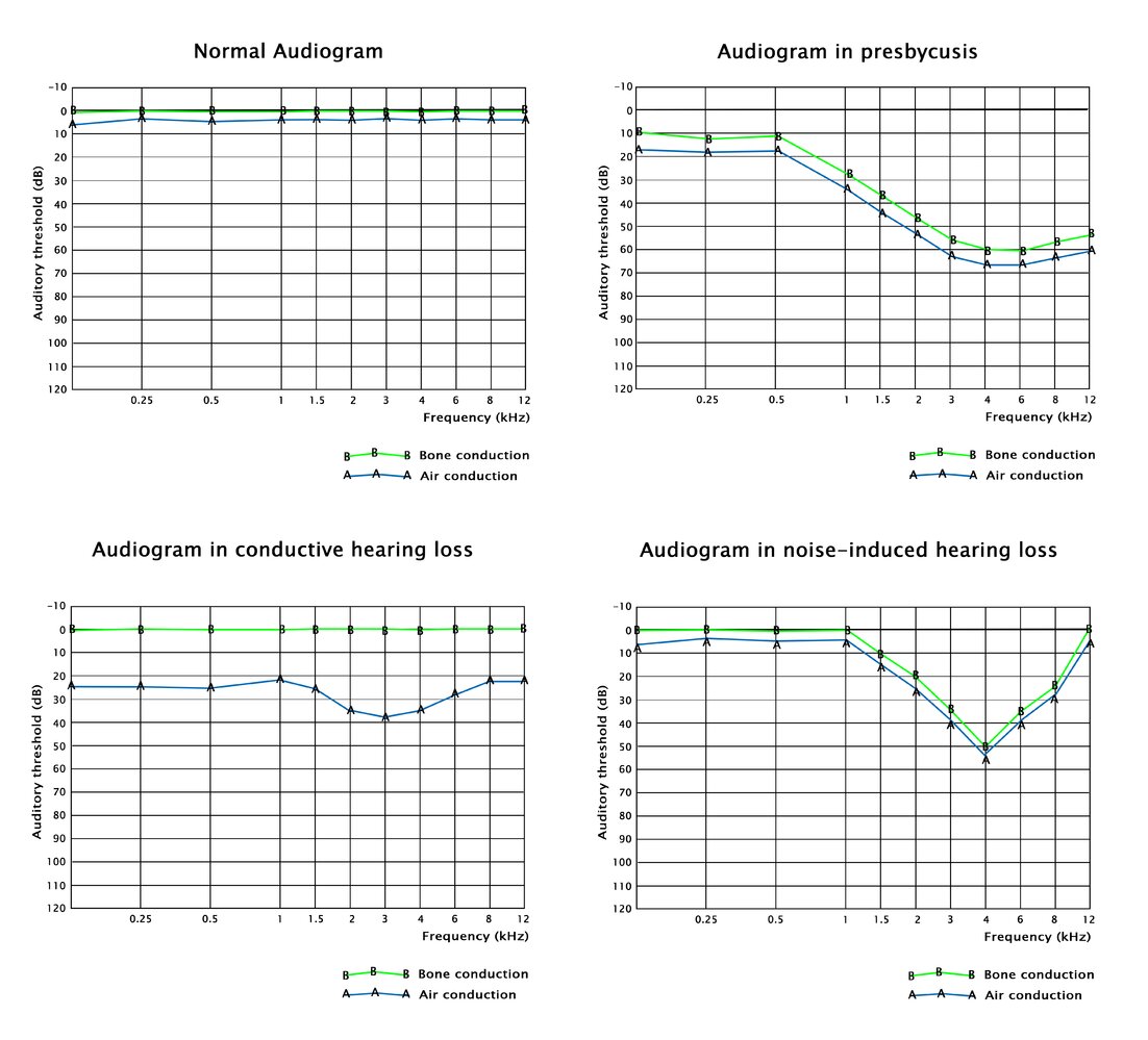 Pure tone audiograms