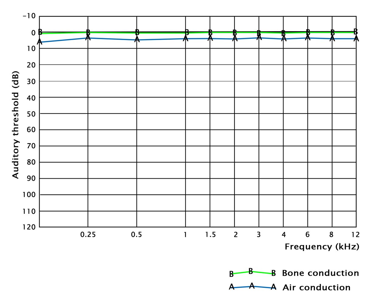 Normal audiogram