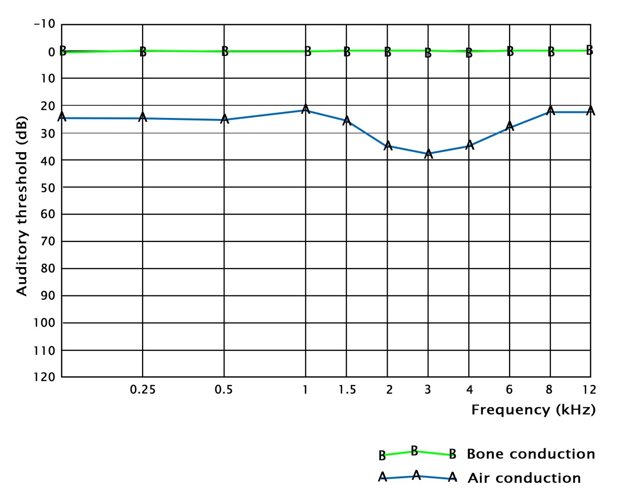 Audiogram in conductive hearing loss