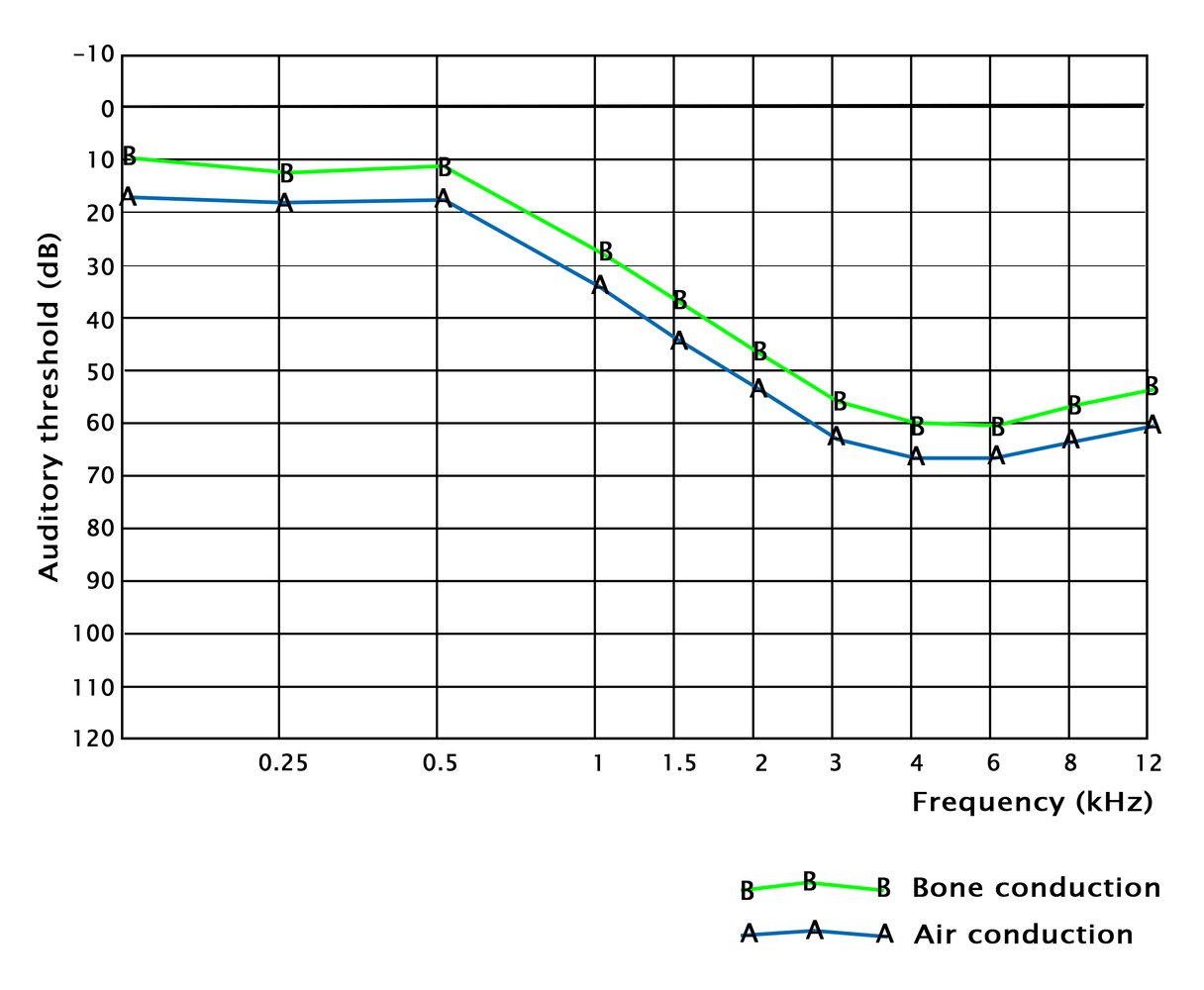 Audiogram in presbycusis
