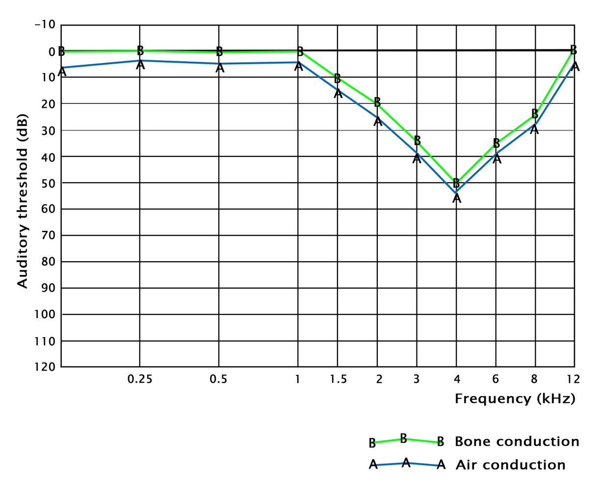 Audiogram in noise-induced hearing loss