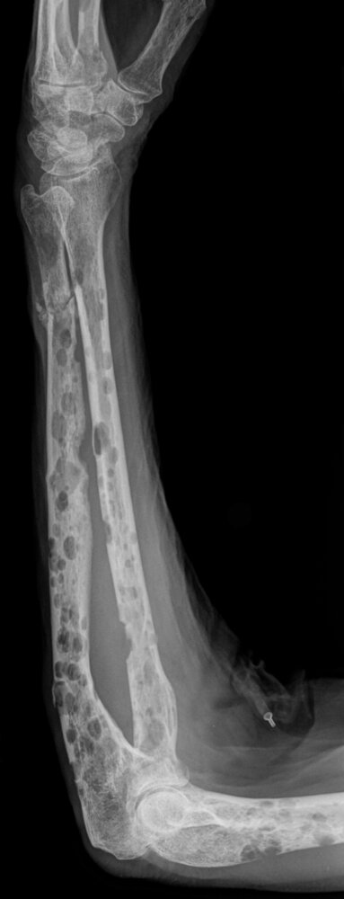 Osteolytic lesions in multiple myeloma