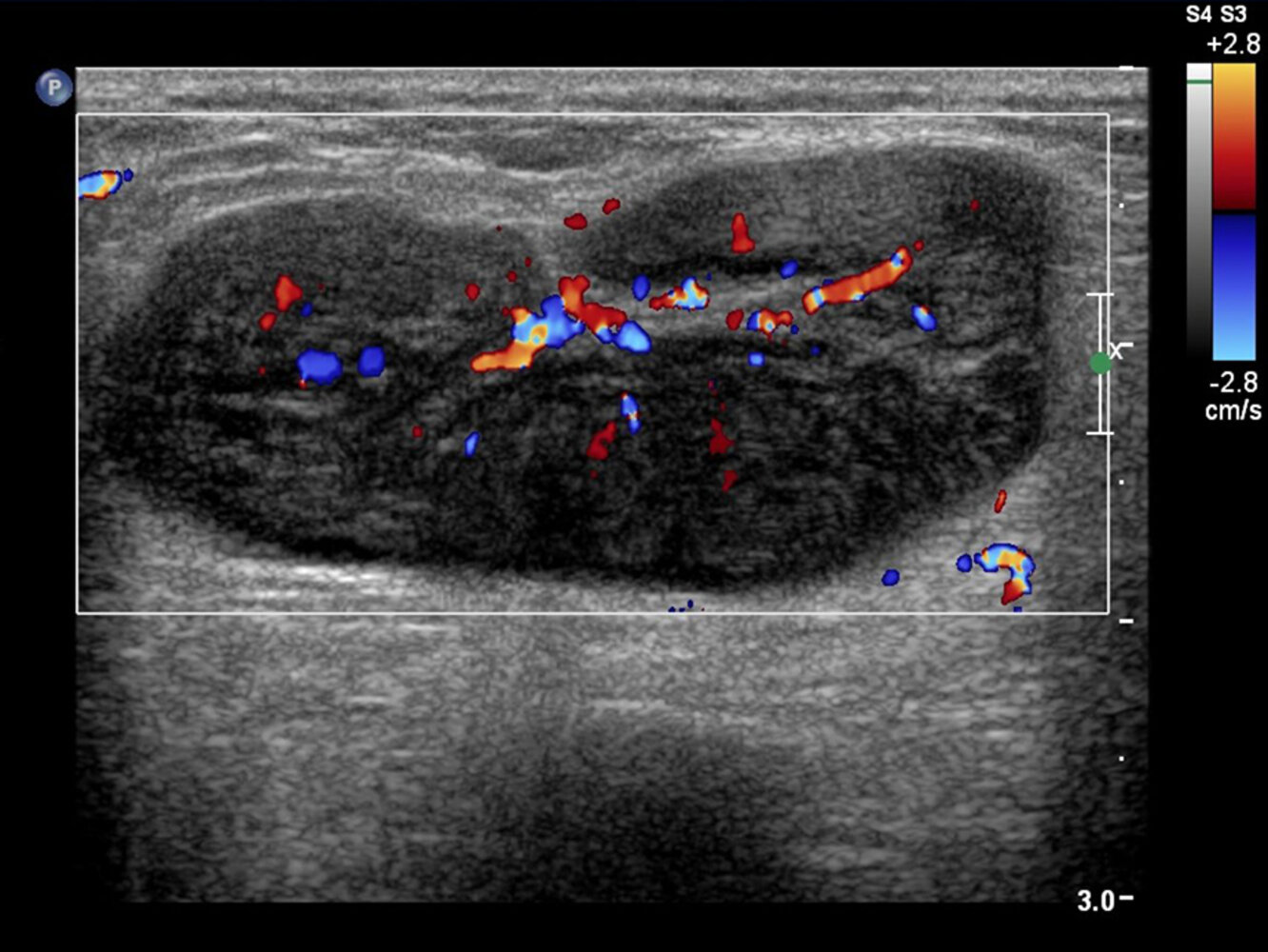 Abnormal lymph node in lymphoma