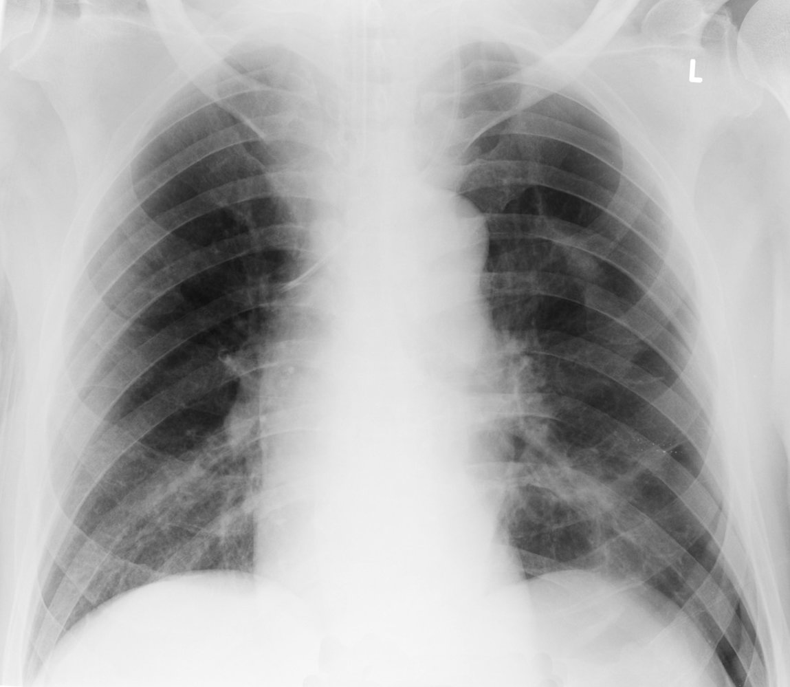 Deep sulcus sign