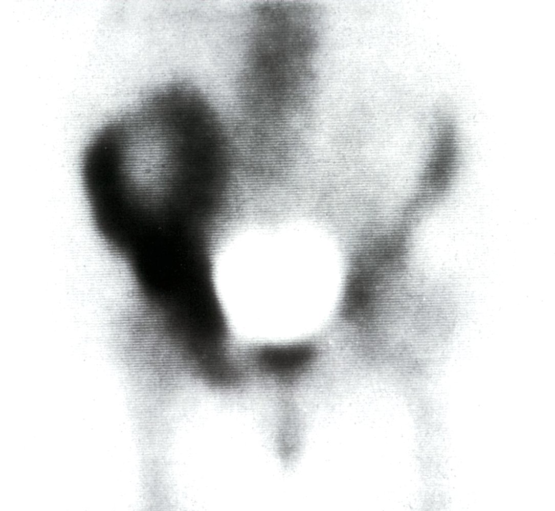 Nuclear medicine bone scan in Paget disease of the bone