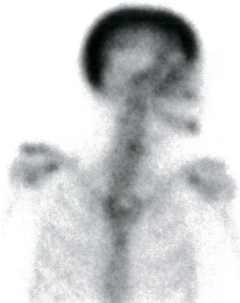 Nuclear medicine bone scan in Paget disease