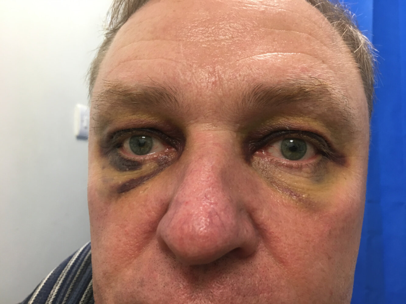 Bilateral periorbital ecchymosis