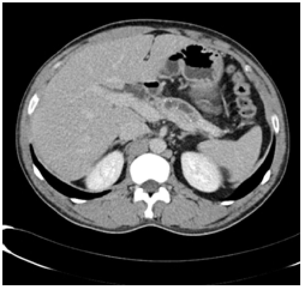 String-of-beads (chain-of-lakes) sign in chronic pancreatitis
