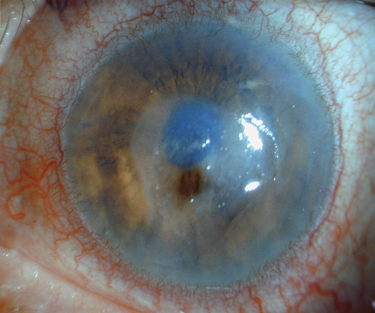 Perforated corneal ulcer