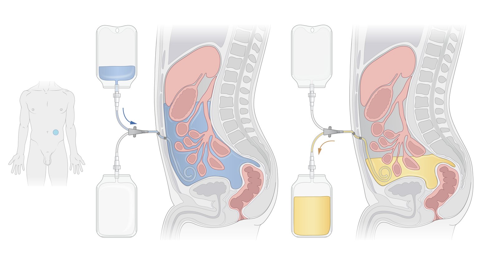 Peritoneal dialysis