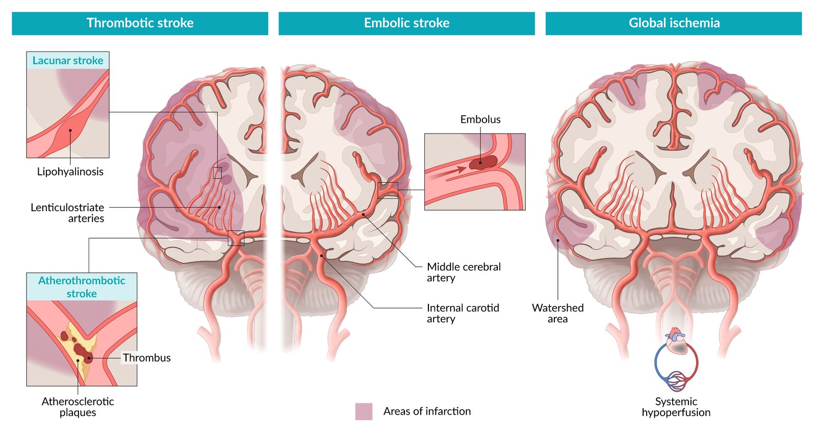 Types of ischemic stroke